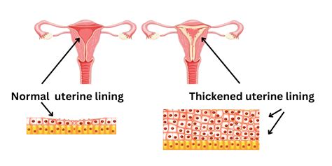 what is uterus in tagalog|UTERUS: Tagalog.